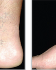 Broadband Light (BBL) - Broken Capillaries (Thighs + Legs)