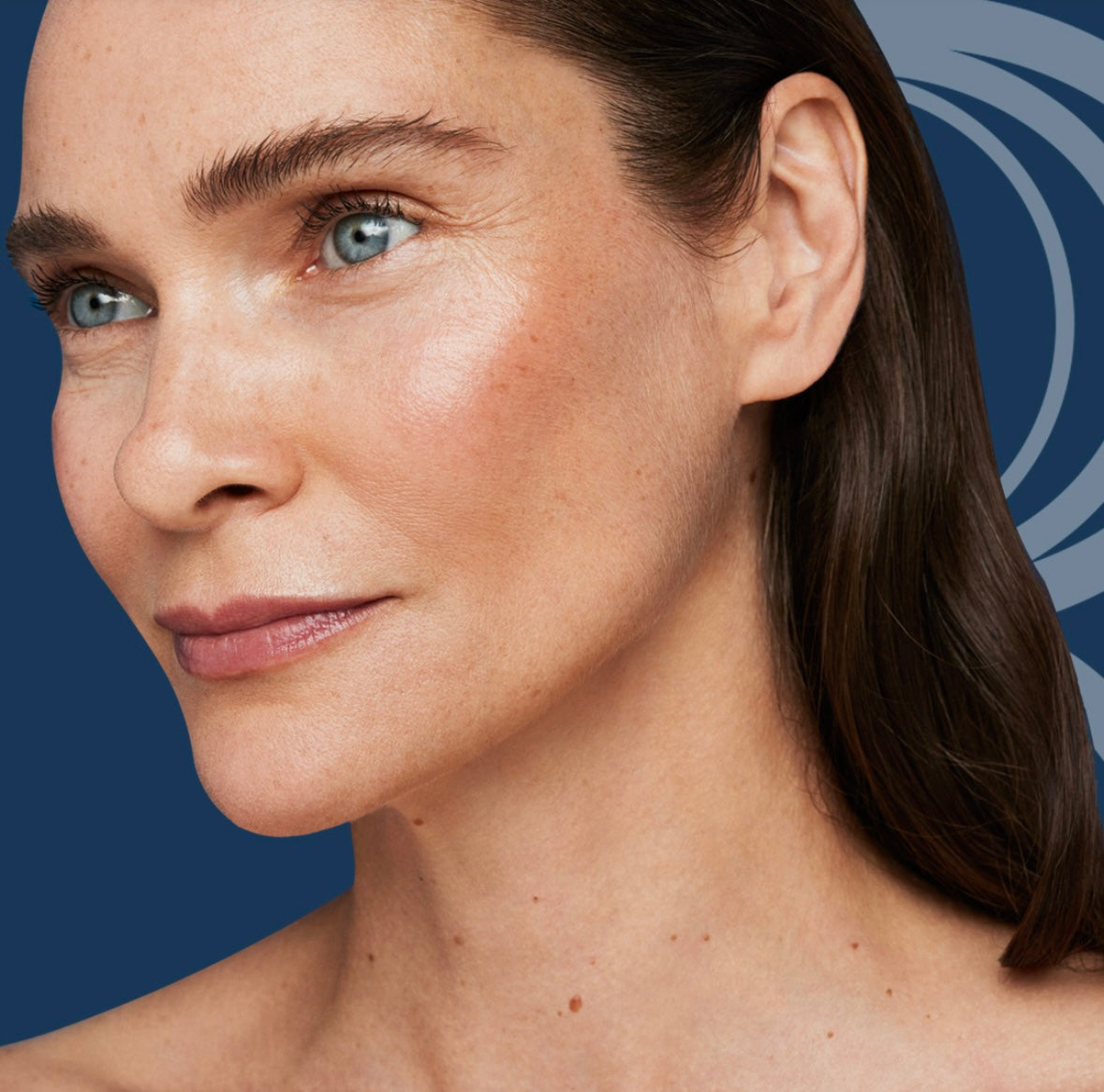Radiesse Chin/Jaw Implant