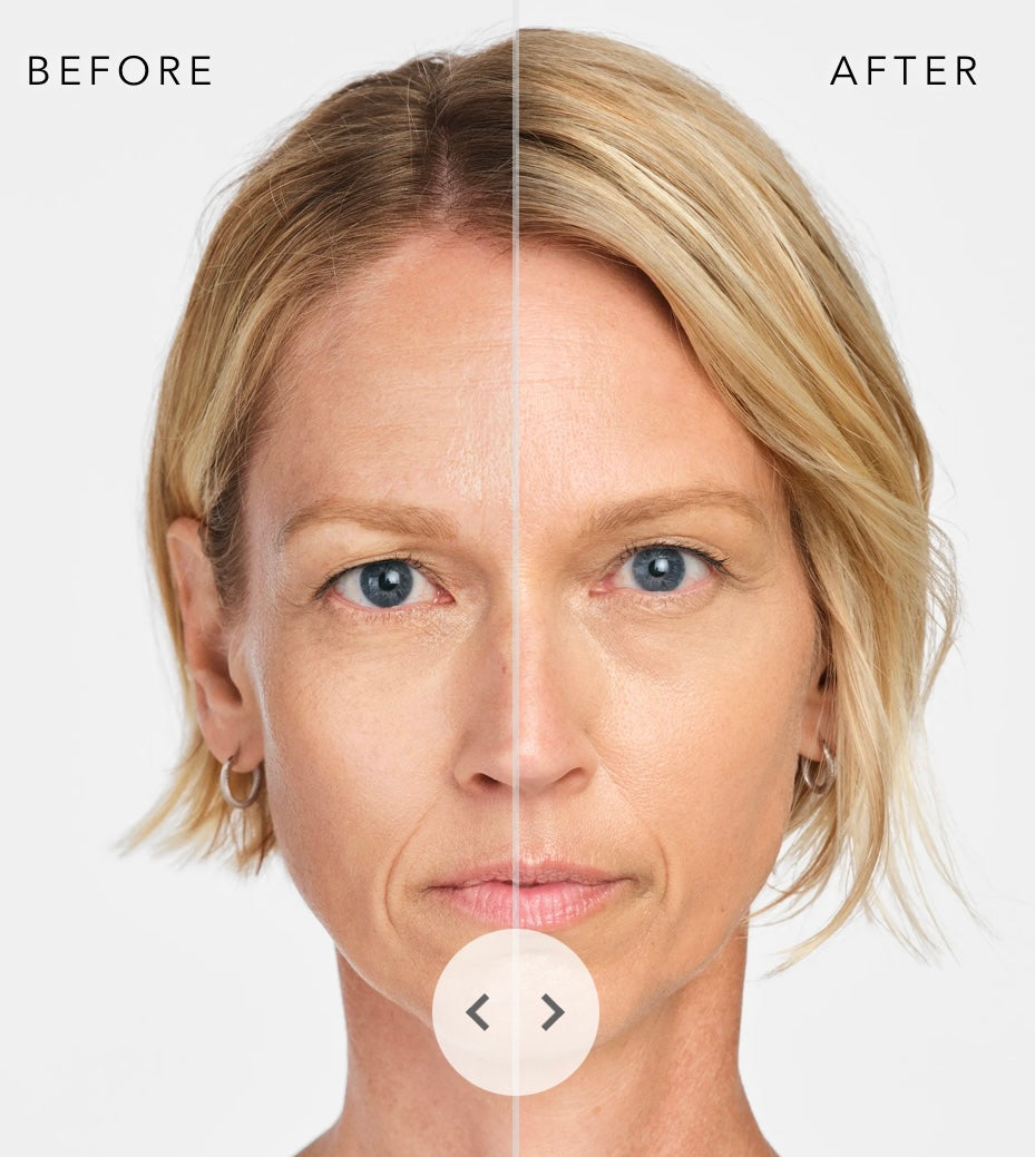 Radiesse Chin/Jaw Implant